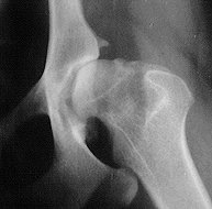dysplastic hip
